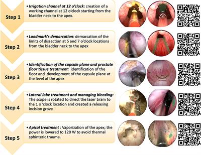 thulium laser vs green light laser